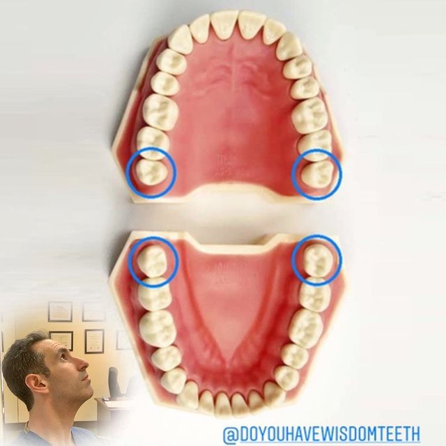 Typodont showing the 4 wisdom teeth / third molars